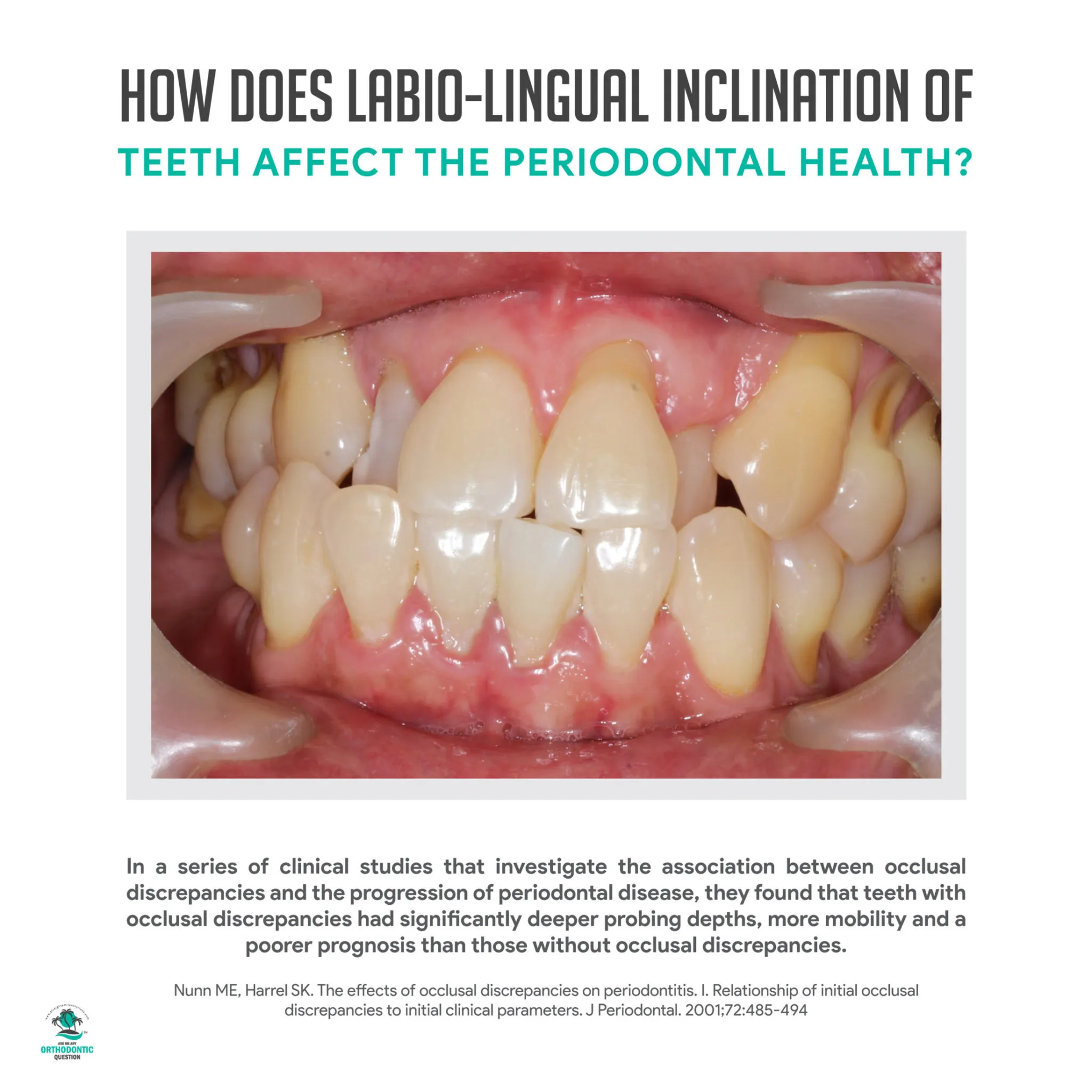 Labio Lingual Inclination And Periodontal Health