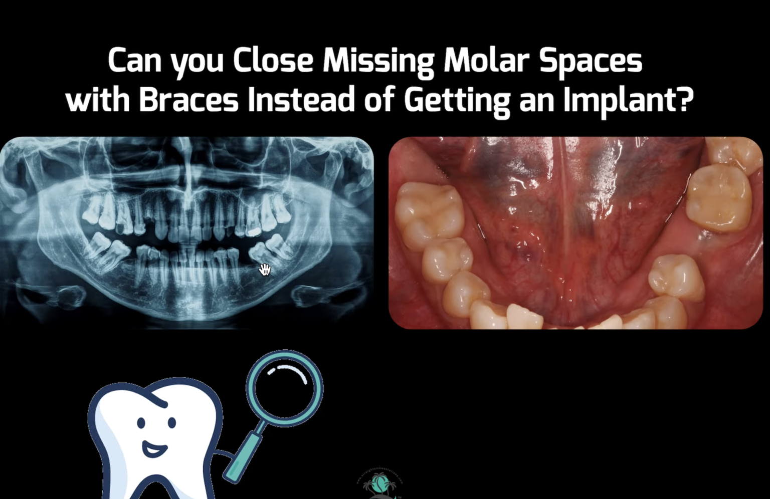 Close Missing Molar Spaces with Invisalign or Braces