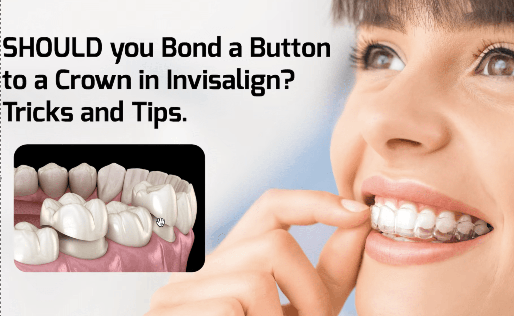 Bonding Buttons to Crowns in Invisalign: Should You Do It?